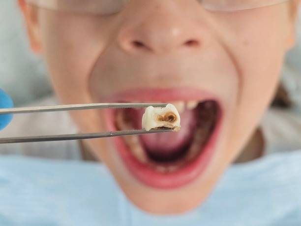 Best Emergency Tooth Extraction in Newport, SC